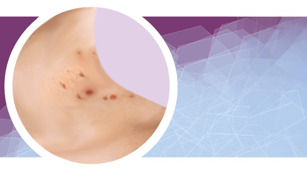 trattamento-crioterapico-slide-new