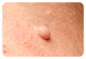 Fibromi-localizzazione-2