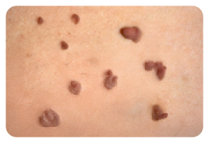 Fibromi-localizzazione-3